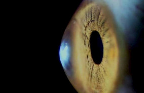 ep la cornea la lente mas externa del ojo se debilita con el paso del tiempo