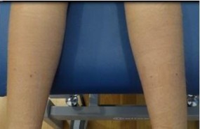ep cirugia minimamente invasivagemelos