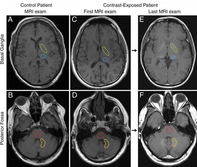 Presencia de gadolinio en el cerebro | SOCIEDAD RADIOLÓGICA DE AMÉRICA DEL NORTE ep presenciagadoliniocerebro